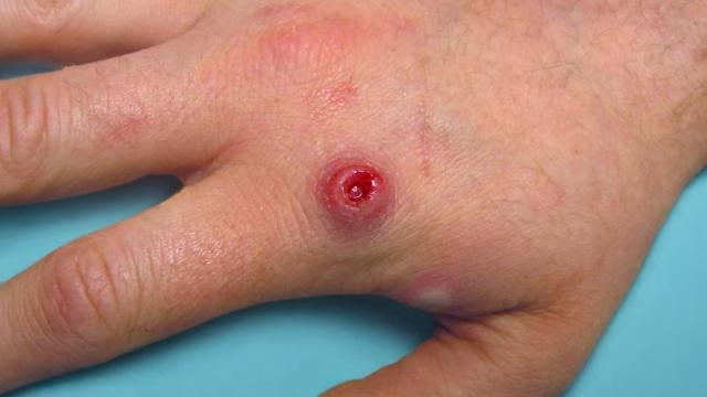 Forstå Monkeypox og hvordan man kan forhindre det?